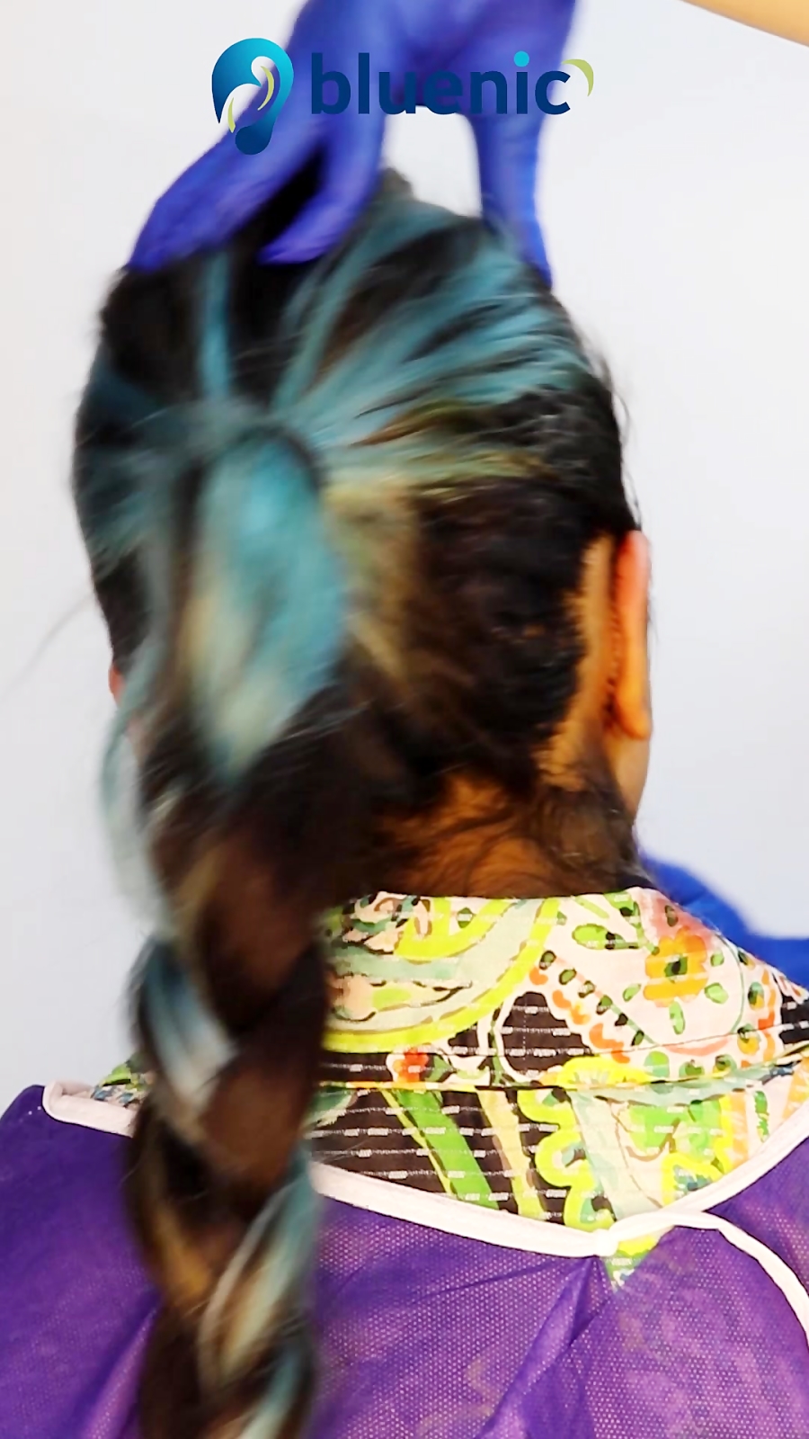 جراحی اتوپلاستی یا ترمیم بیرون زدگی گوش شبیه به یک معجزه عمل کرد!