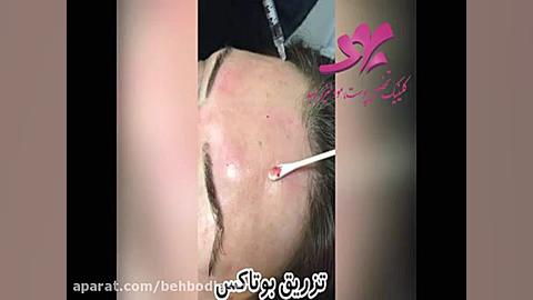 تزریق بوتاکس کاندسارتان
