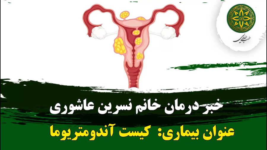 خبر بهبودی کیست آندومتریوما | طب طلایی | 09190417521