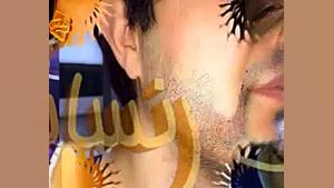 کاشت ریش و سبیل به روش SUT مرکز مو رنسانس بیومهندسی عصبی