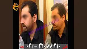 کاشت ریش و سبیل به روش SUT مرکز مو رنسانس ایربسارتان