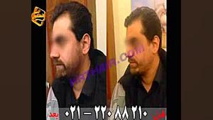 کاشت ریش و سبیل به روش SUT مرکز مو رنسانس ژنراتور پالس عصبی