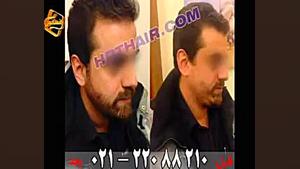 کاشت ریش و سبیل به روش SUT مرکز مو رنسانس اصلاح طرح لبخند