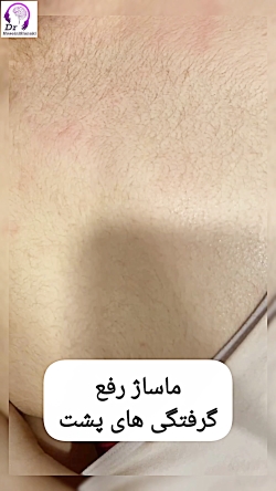 ماساژ رفع گرفتگی‌های پشت (تریگرپوینت)