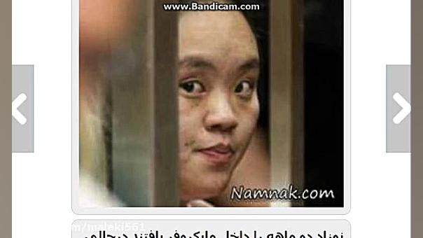 سوختن نوزاد دوماهه داخل مایکروفر تزریق ژل