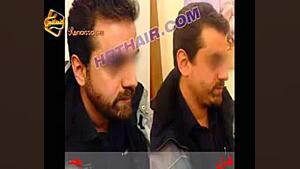 کاشت ریش و سبیل به روش SUT مرکز مو رنسانس Live Cell Microscopy
