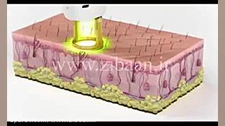 روش انجام لیزر موهای زائد پروتز سینه