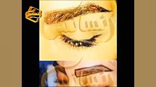 کاشت ریش و سبیل به روش SUT مرکز مو رنسانس درمان ریزش مو