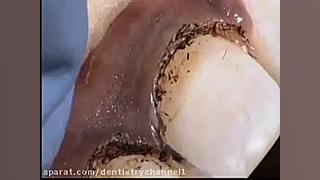 جراحی لثه با لیزر کاپوت سکودانئوم