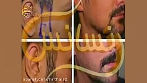کاشت ریش و سبیل به روش SUT مرکز مو رنسانسکاشت ریش و سبی زیبایی پوست