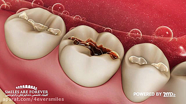 پر کردن دندان با مواد امالگام پزشکی هیپر باریک