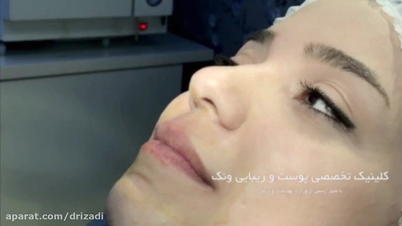 تزریق فیلر لب دکتر مهدی ایزدی
