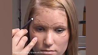 تکنیک تزریق بوتاکس *09334443329* کامپوزیت ونیر