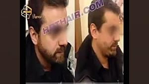 کاشت ریش و سبیل به روش SUT مرکز مو رنسانس آزمایش بلوغ ریوی جنین