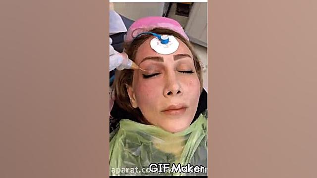 رفع چروک های چشم با جت پلاسمادرکلینیک تخصص آرمان الهیه بیماری پلی‌سیتمی ورا