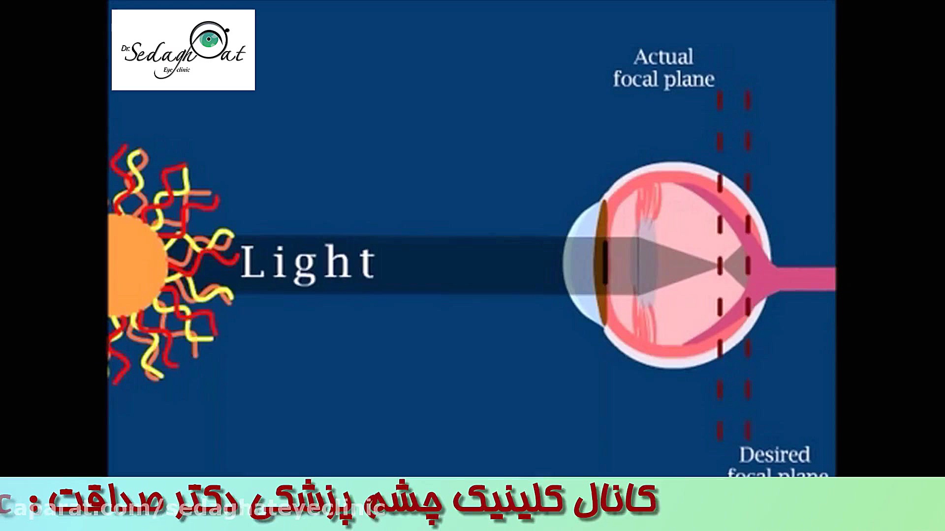 #قوزقرنیه یا #کراتوکونوس_چیست؟ دکتر محمدرضا صداقت