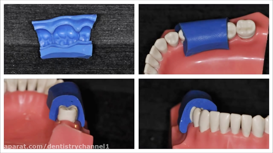 Временные коронки прямым методом. Силиконовый блок для временных коронок. Слепок для временных коронок. Силиконовый ключ в стоматологии.