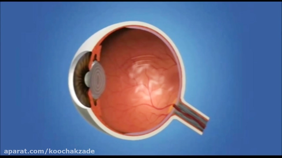 What Causes Eye Floaters and Blurred Vision Symptoms and Treatment