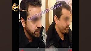 کاشت ریش و سبیل به روش SUT مرکز مو رنسانس پزشکی دریایی