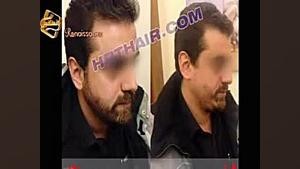 کاشت ریش و سبیل - کاشت مو و ترمیم مو رنسانس ایم‌دولیموماب