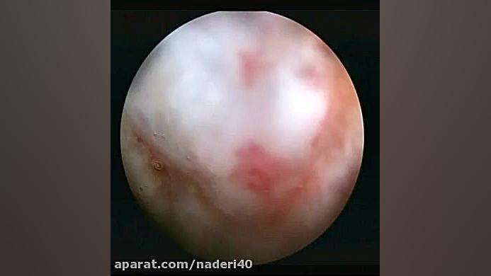 فیلم کوتاه از درمان آرتروسکوپی دررفتگی مکرر شانه کربوکسی تراپی