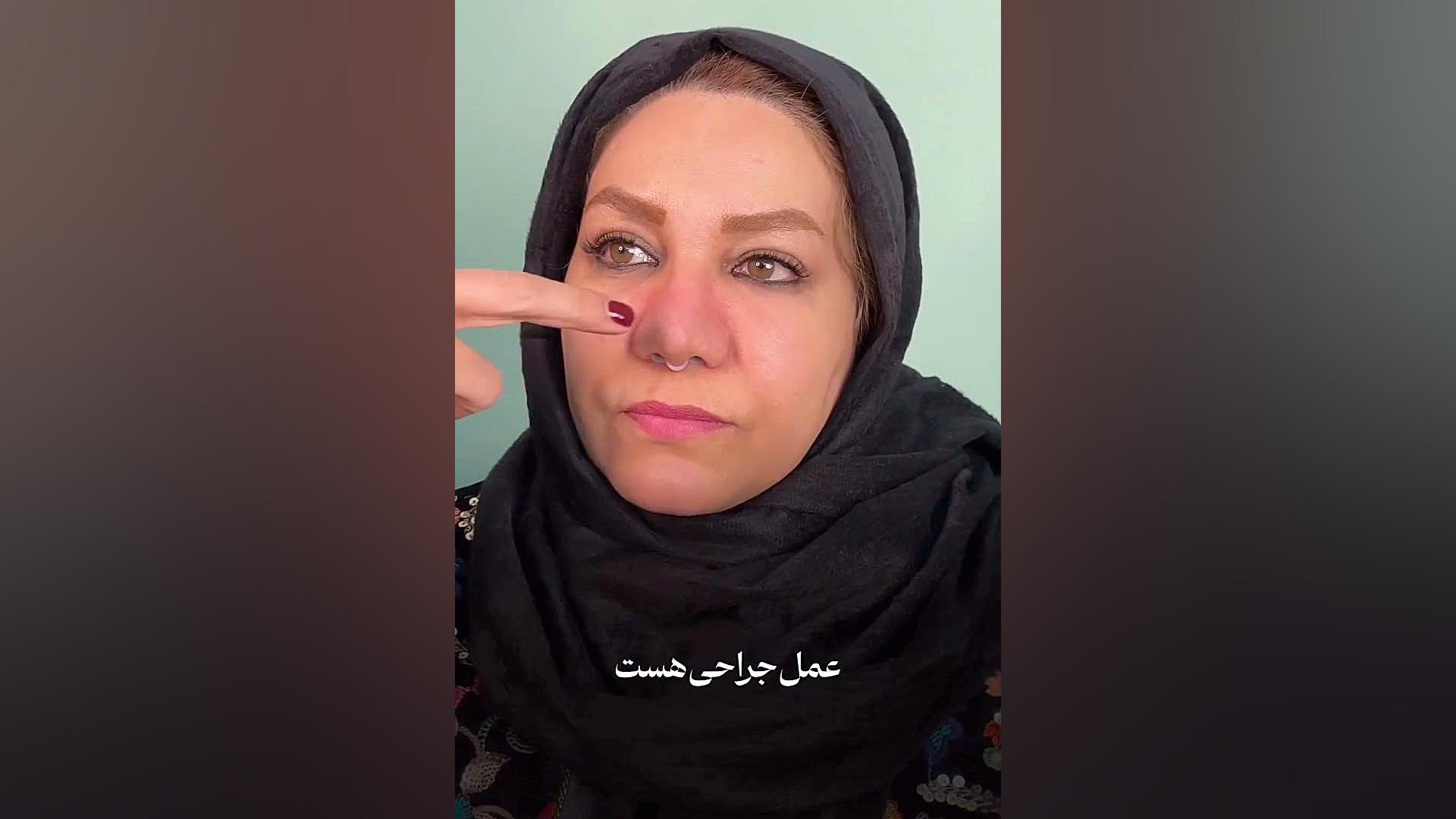 دو هفته بعد از عمل بینی گوشتی | دکتر ماریا مرادی