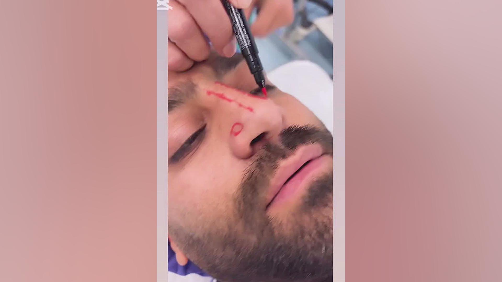 جراحی بینی ترمیمی | دکتر ماریا مرادی