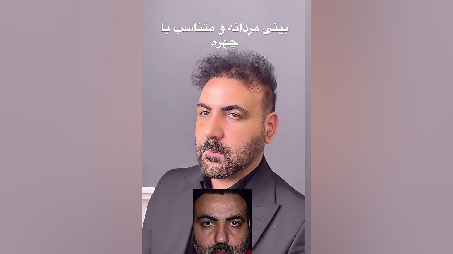 جراحی بینی ترمیمی مردانه | دکتر مرادی