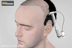 معرفی کلی از کاشت مو