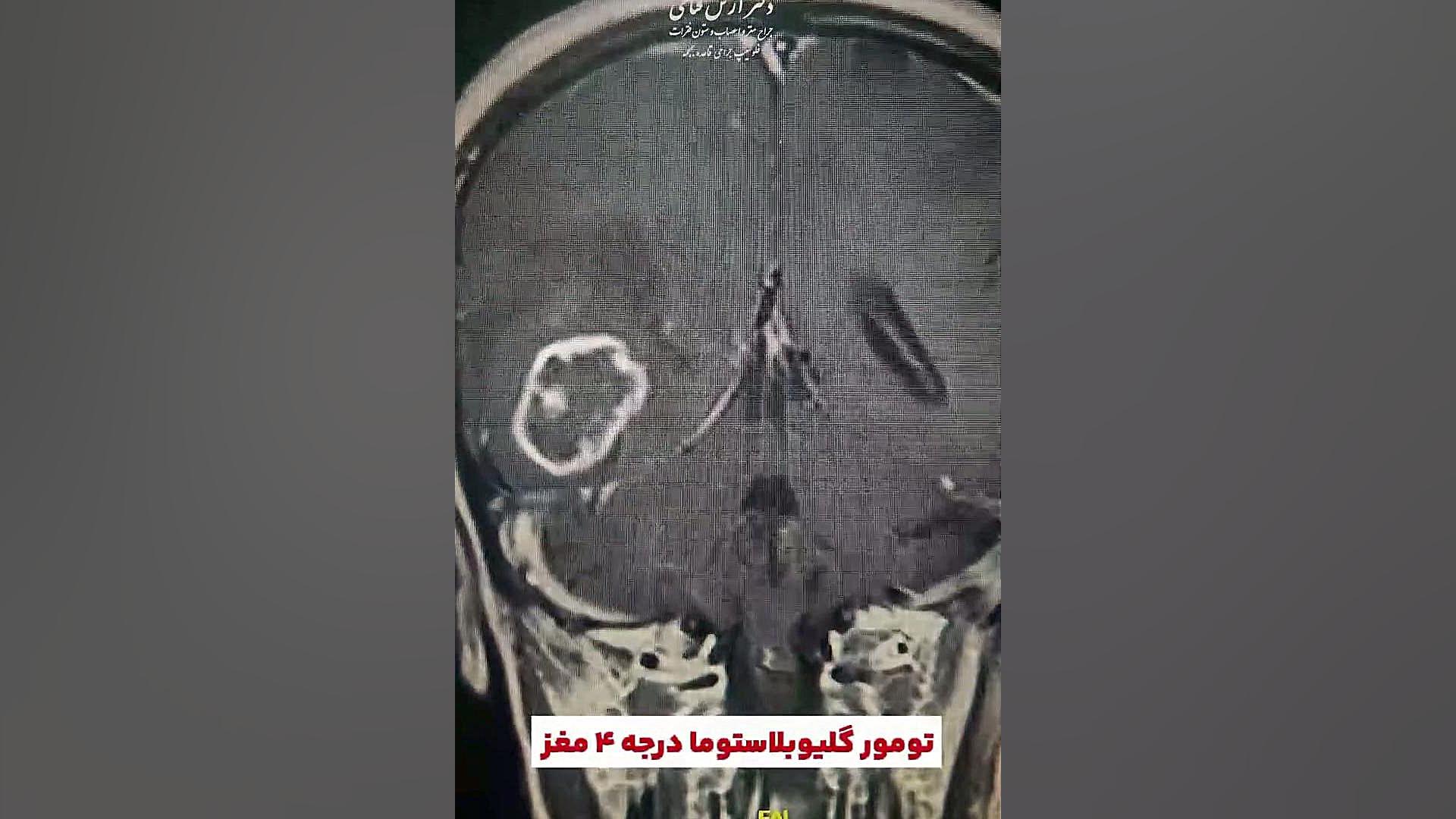 تومور مغزی درجه چهار | دکتر آرش فتاحی