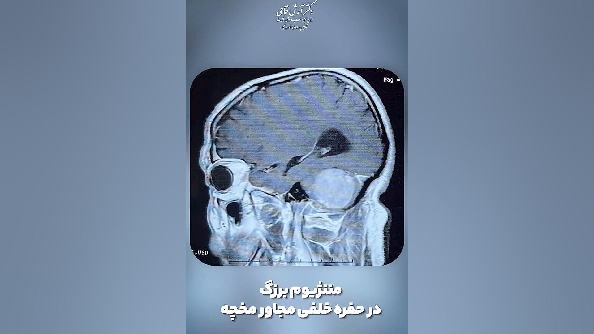 عمل موفق مننژیوم بزرگ | دکتر آرش فتاحی