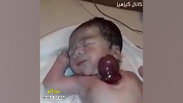 قلب این نوزاد وقتى بدنیا آمد خارج از قفسه سینه اش قرار داشت !طبق گزاراشات در د دکتر پوست