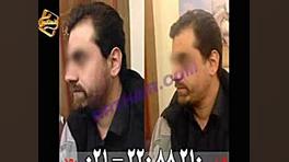 کاشت ریش و سبیل به روش SUT مرکز مو رنسانس ایکلوزوماب