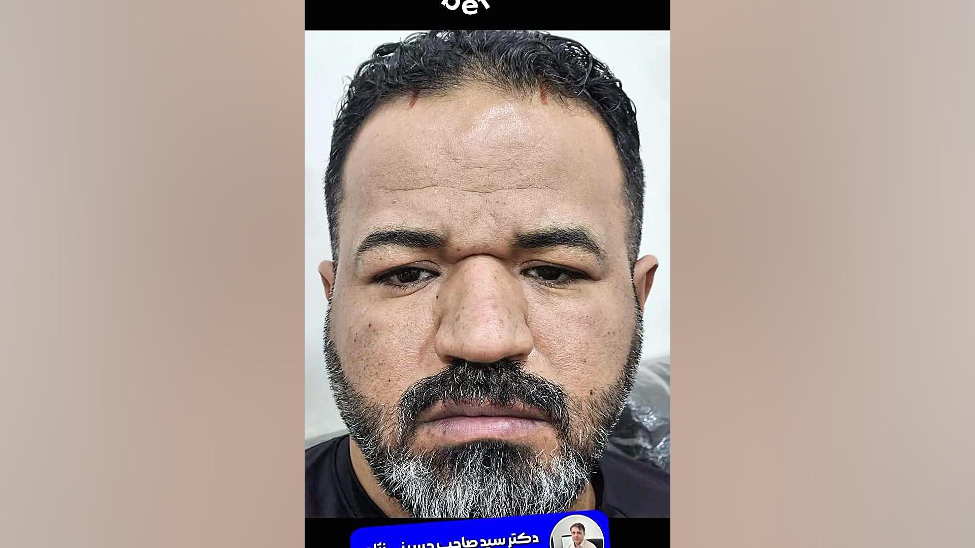 لیفت آندوسکوپی ابرو و شقیقه | دکتر صاحب حسینی نژاد