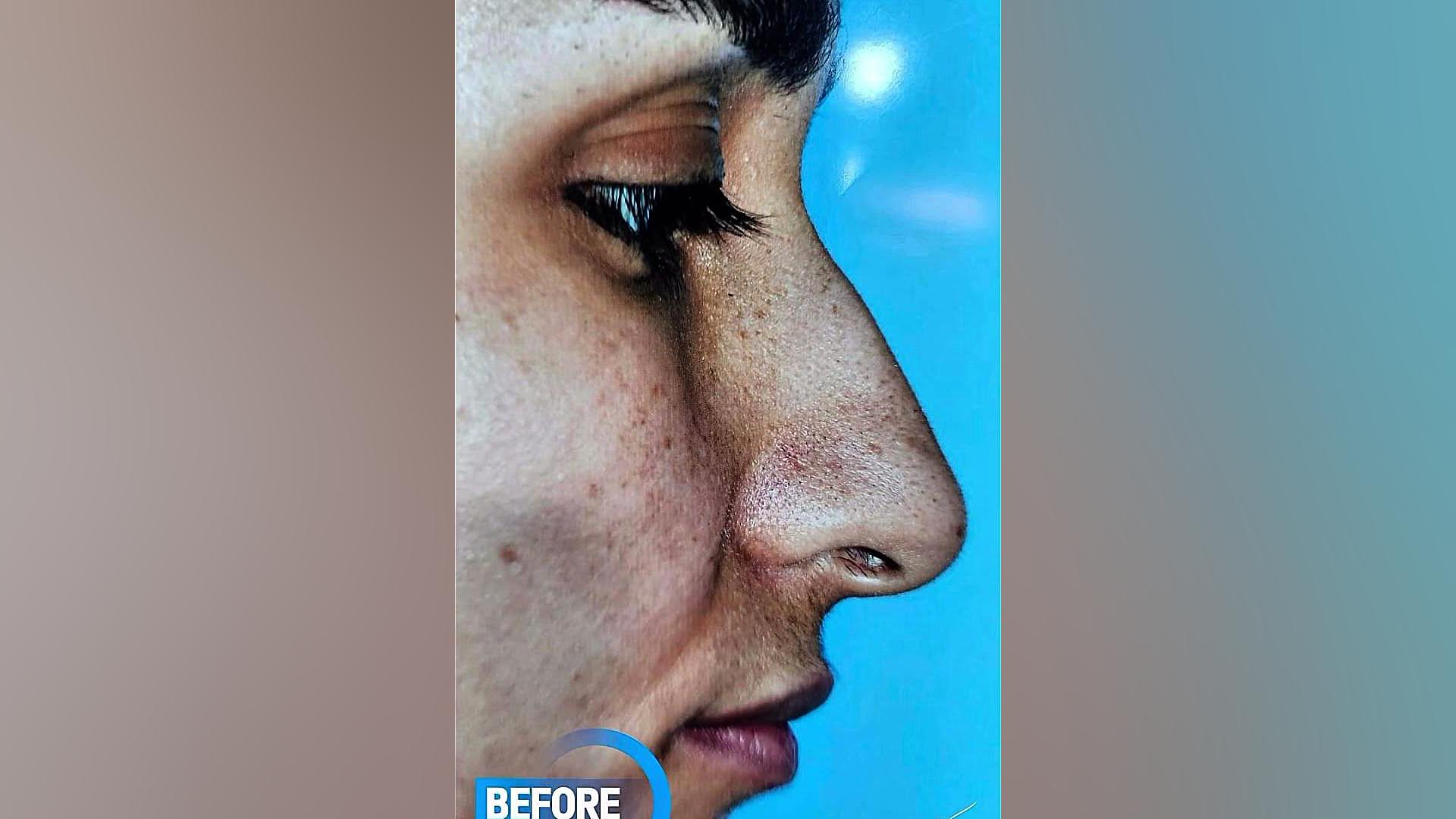 جراحی زیبایی بینی با دکتر حسینی نژاد