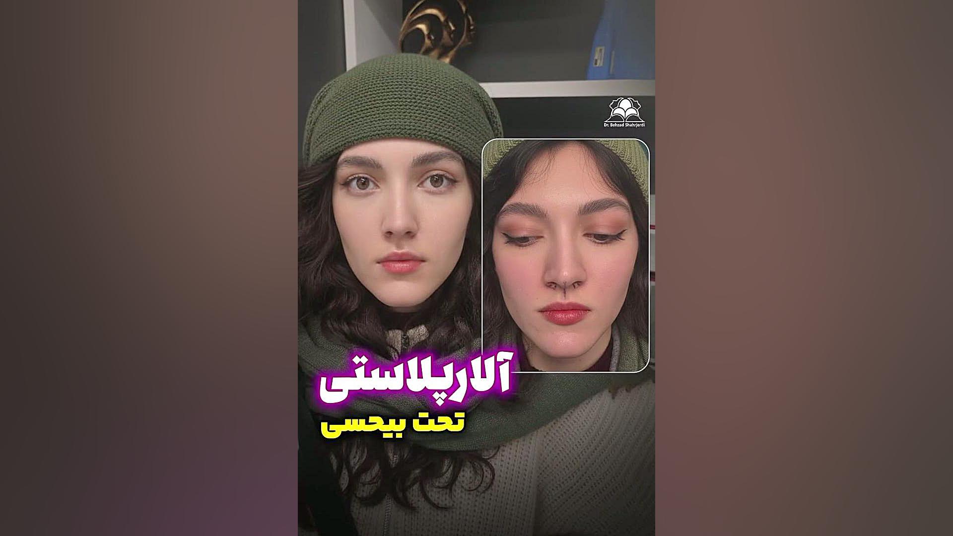 آلارپلاستی | دکتر بهزاد شهرجردی