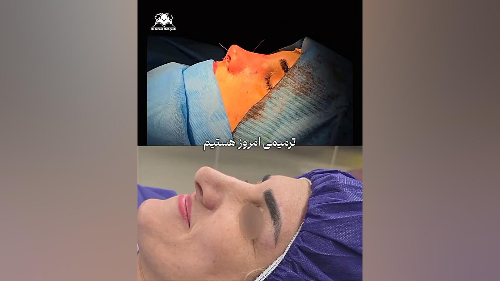 جراحی بینی ترمیمی | دکتر شهرجردی