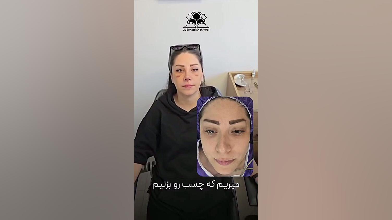 بعد از برداشتن گچ بینی | دکتر بهزاد شهرجردی