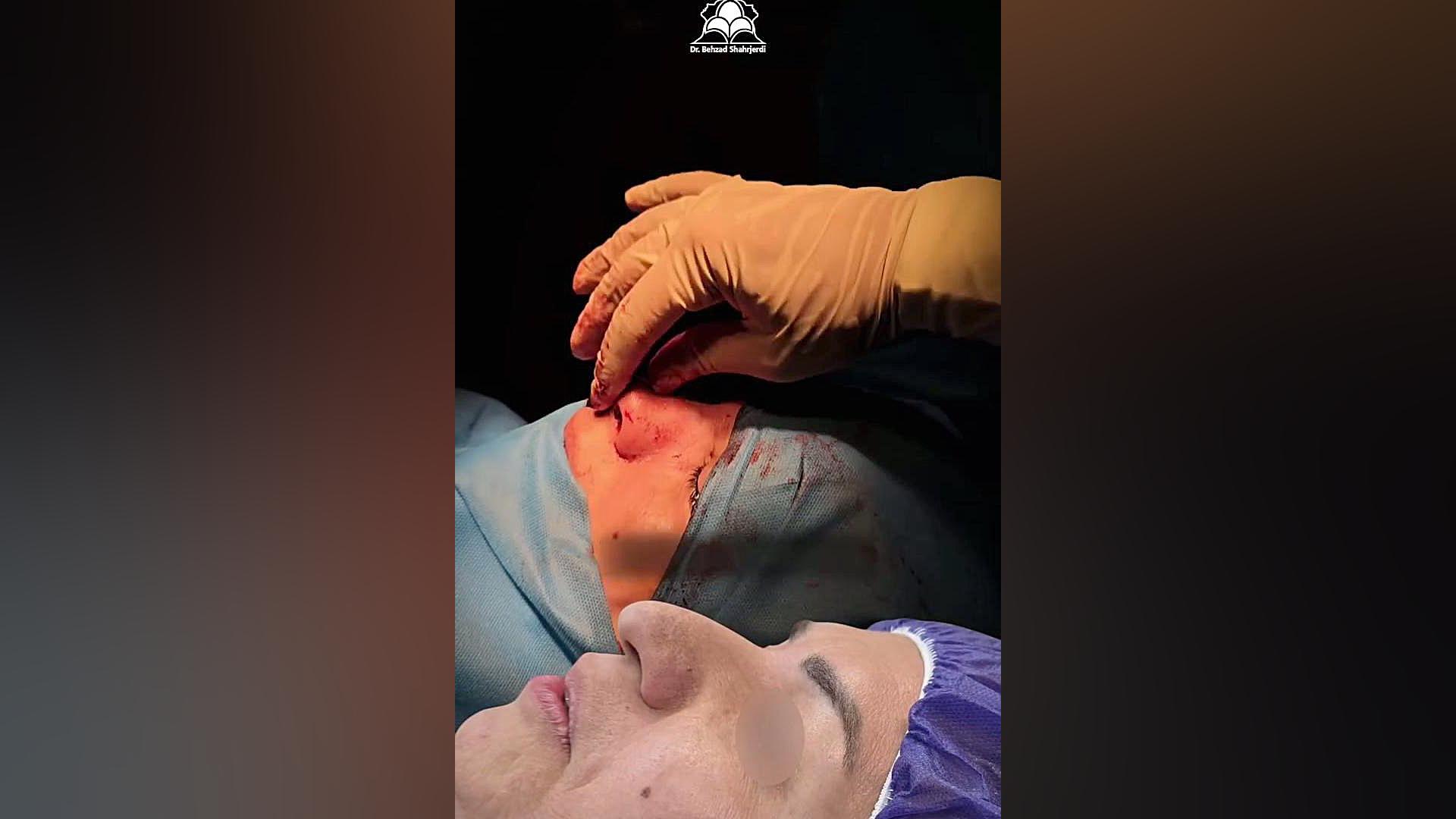 جراحی بینی گوشتی در 52 سالگی | دکتر شهرجردی