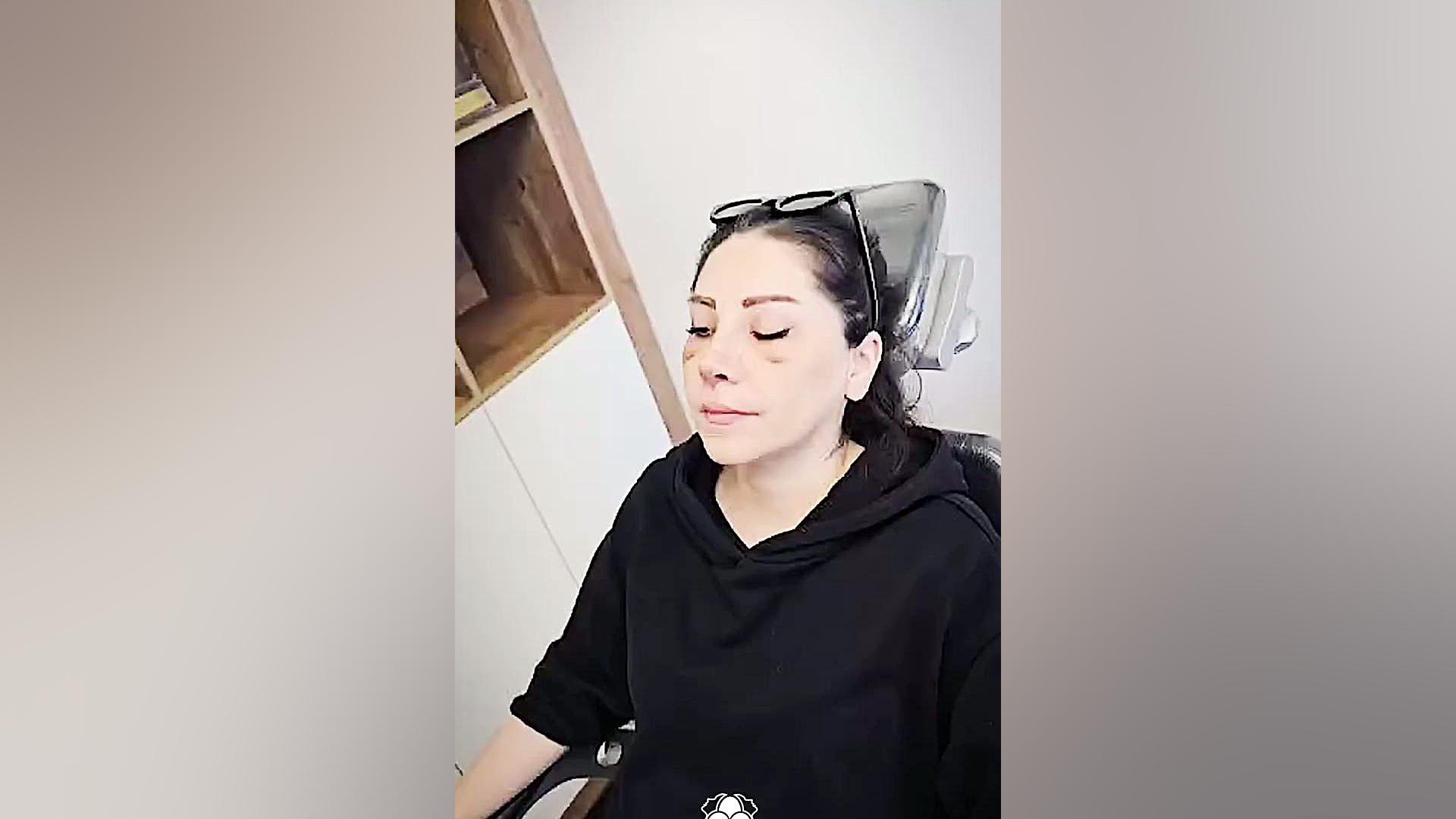 چسب زدن به بینی | دکتر بهزاد شهرجردی