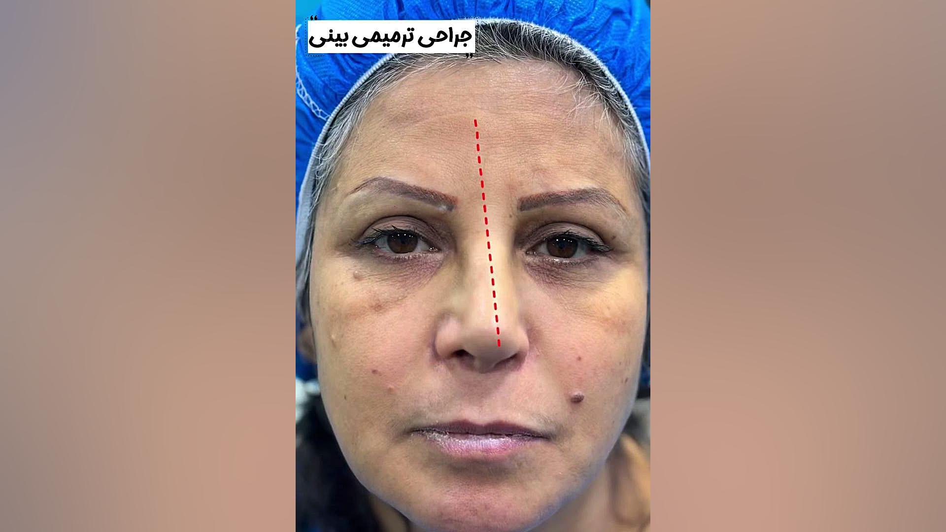 جراحی بینی ترمیمی | دکتر صاحب حسینی نژاد