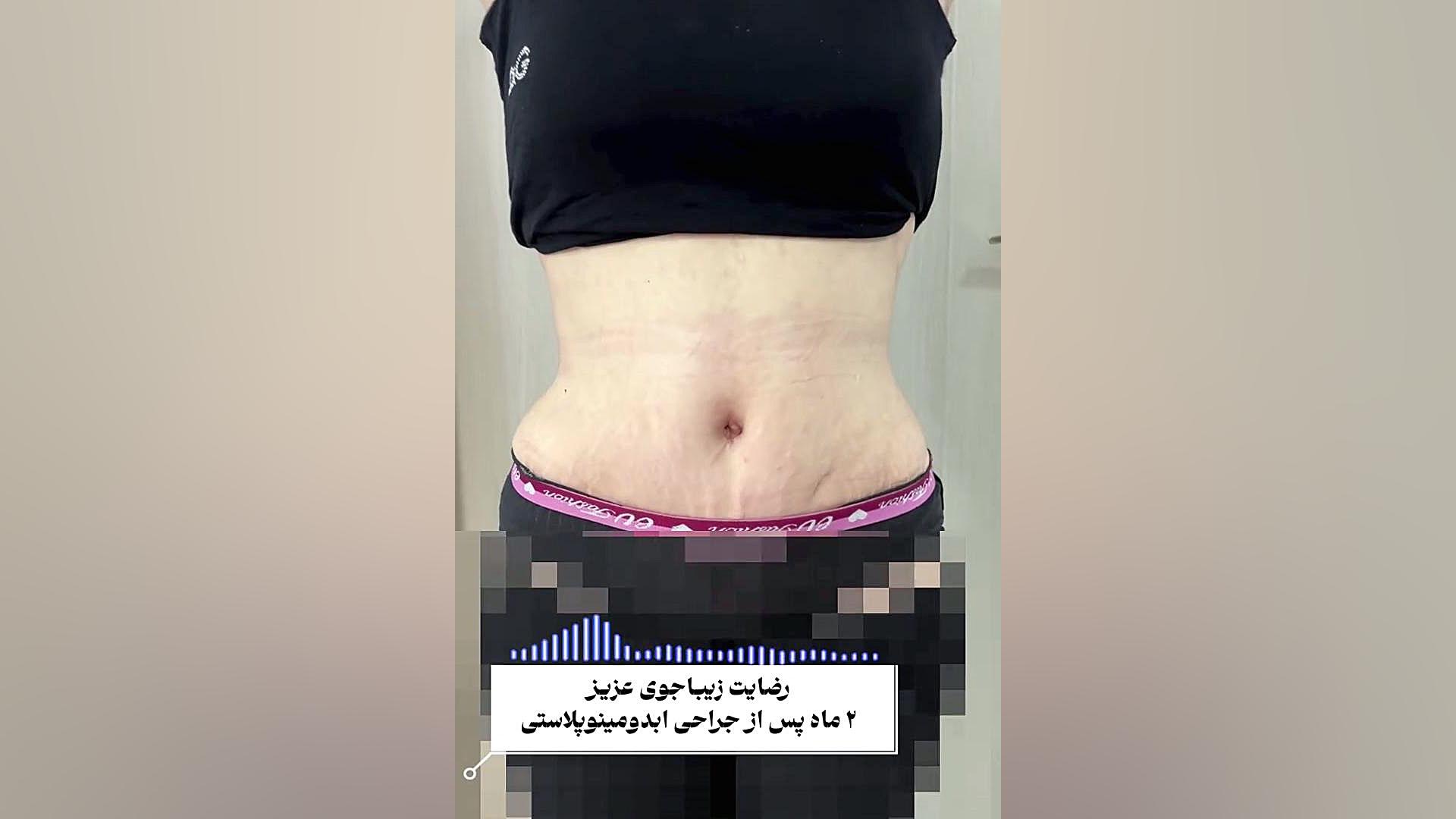 رضایت از ابدومینوپلاستی | دکتر حسینی نژاد