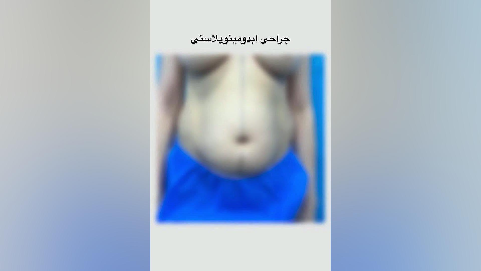 جراحی ابدومینوپلاستی | دکتر حسینی نژاد