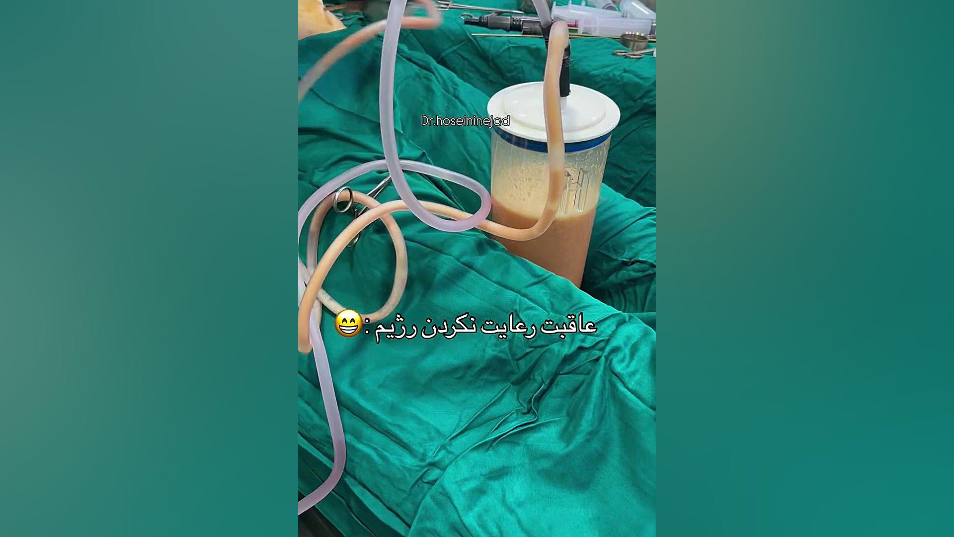 لیپوساکشن | دکتر صاحب حسینی نژاد