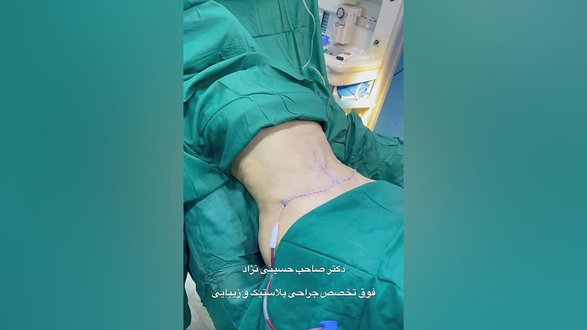 بلافاصله بعد از ابدومینوپلاستی | دکتر صاحب حسینی نژاد