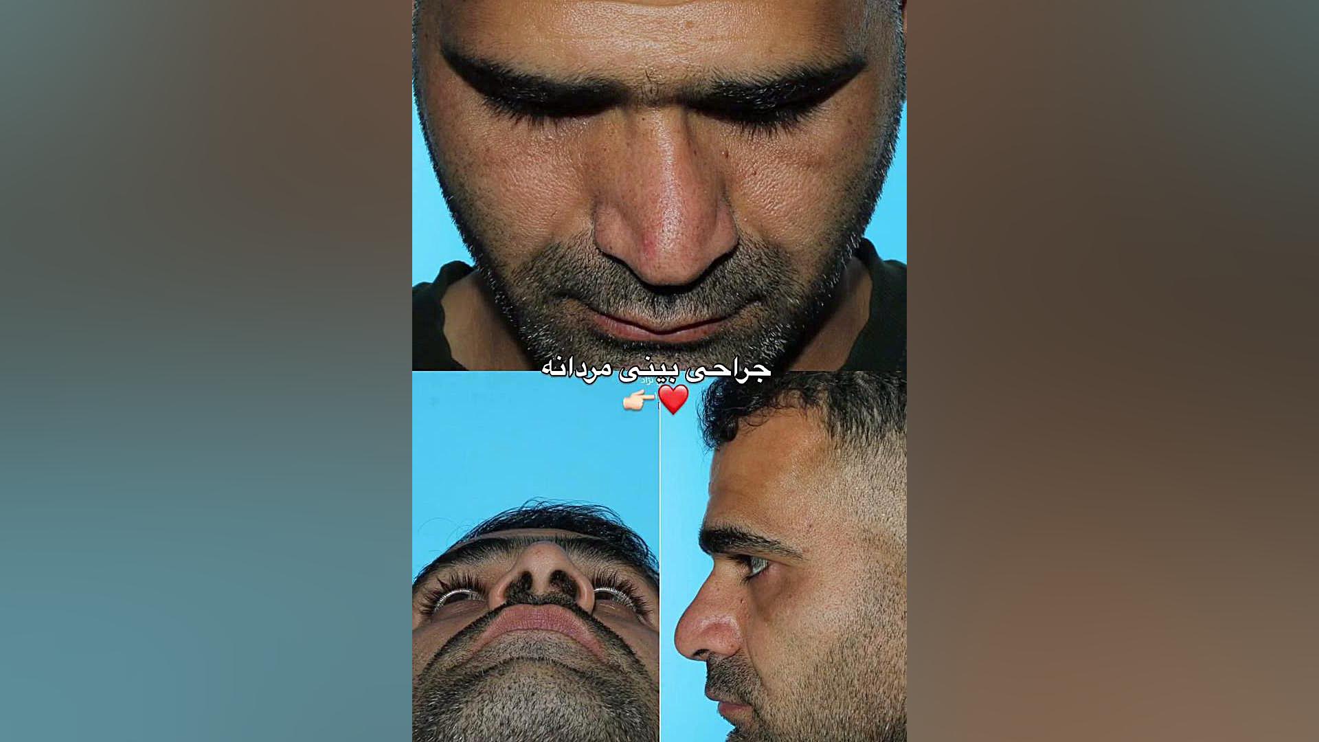 جراحی بینی مردانه | دکتر حسینی نژاد