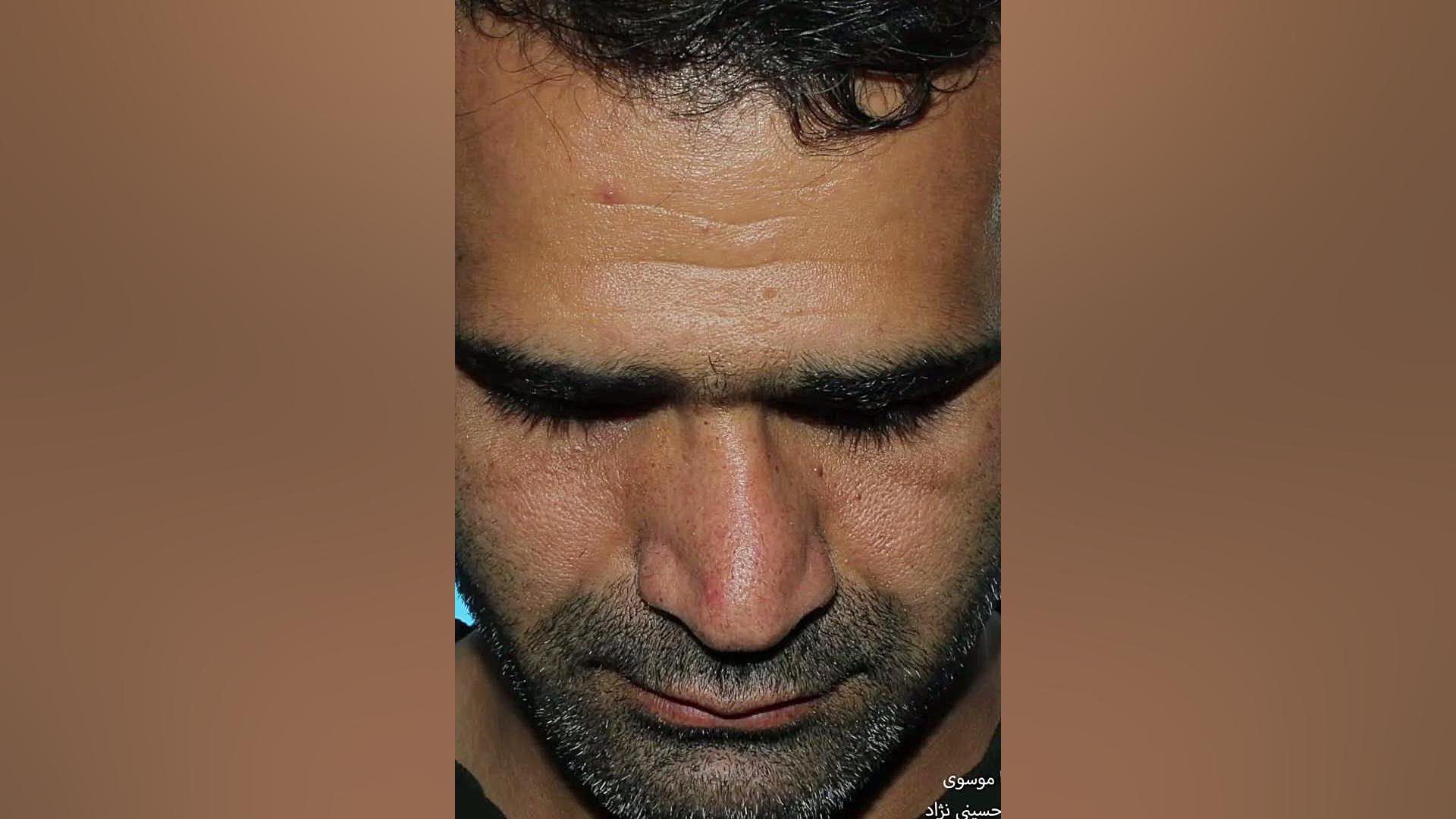 انحراف شدید بینی  | دکتر حسینی نژاد
