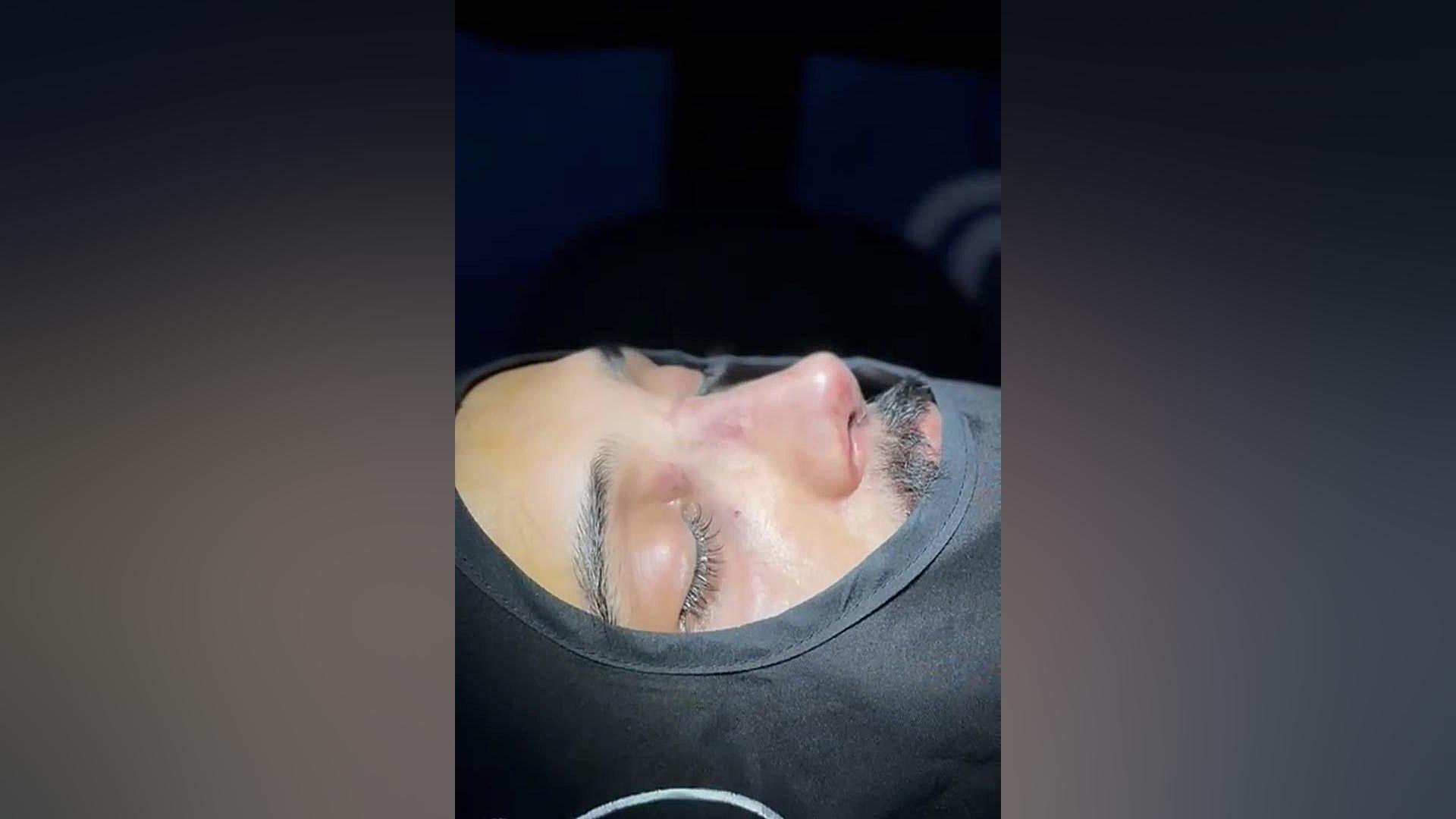 نتیجه ای عالی از عمل بینی | دکتر صاحب حسینی نژاد