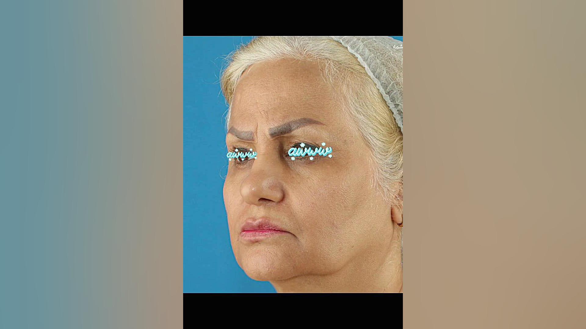 لیفت صورت و تجربه جوانی | دکتر صاحب حسینی نژاد