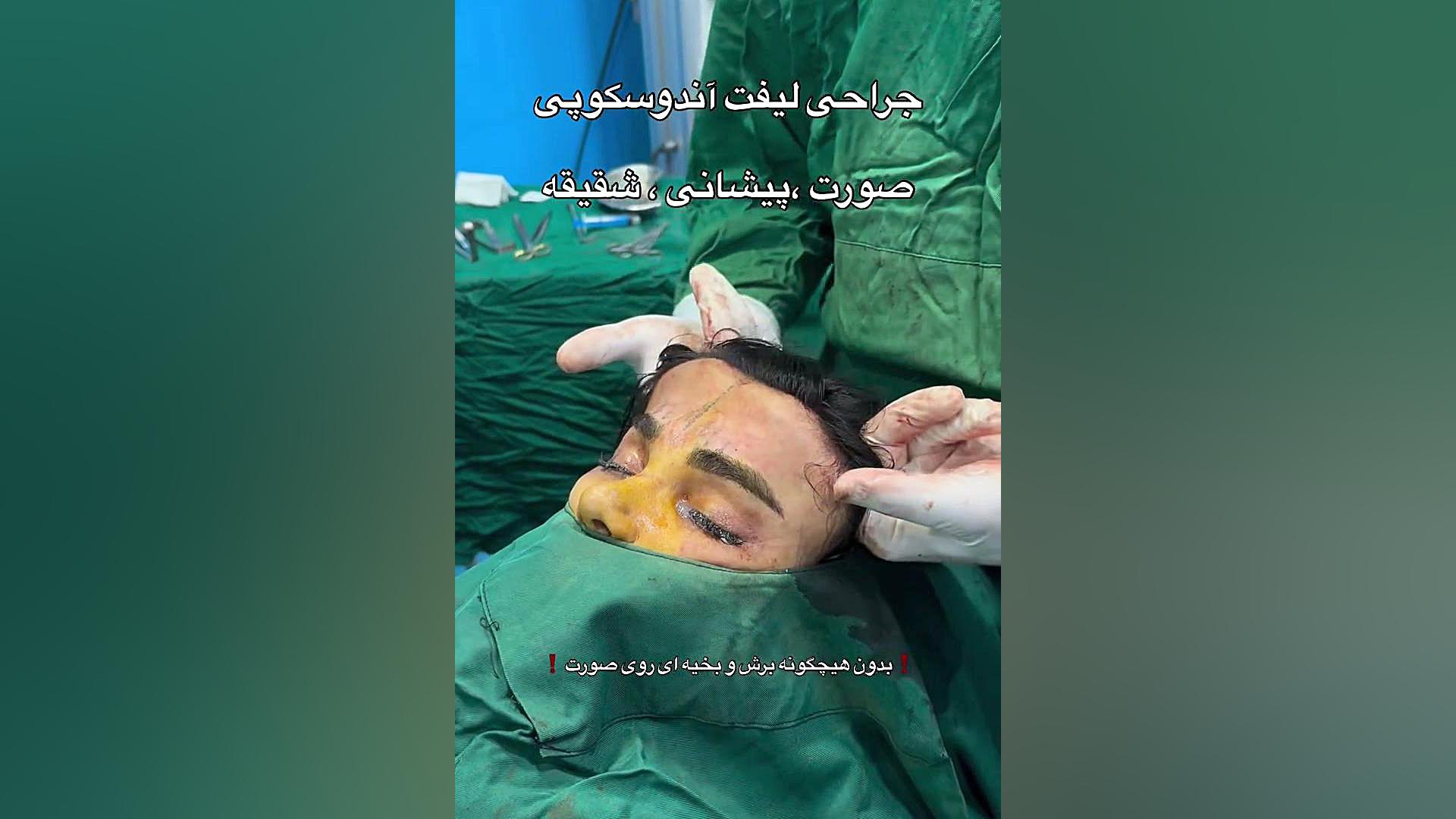 فیلم واقعی جراحی لیفت صورت | دکتر صاحب حسینی نژاد